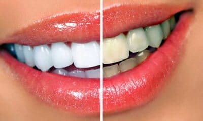Θα θέλατε και εσείς να έχετε λευκά δόντια, εύκολα, γρήγορα και προπάντων φυσικά και ανέξοδα; Φυσικά και θα θέλατε, αφού και λεφτά δεν υπάρχουν